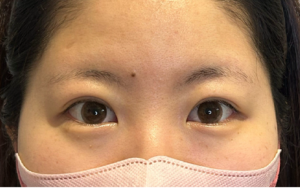 二重埋没法 症例2 アフター 30代女性 施術2週間後