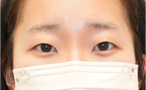 二重埋没法 症例1 ビフォー 20代女性 瞼板法2点留め