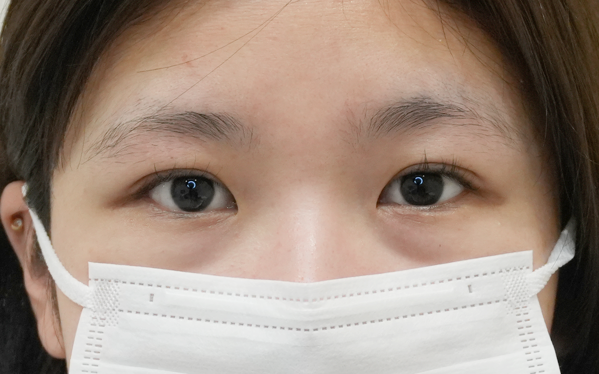 二重埋没法 アフター 20代女性 施術1週間後