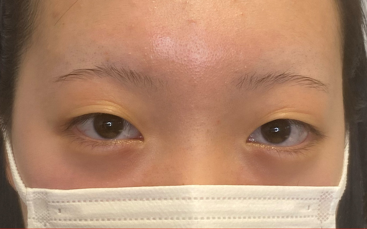 二重埋没法 ビフォー