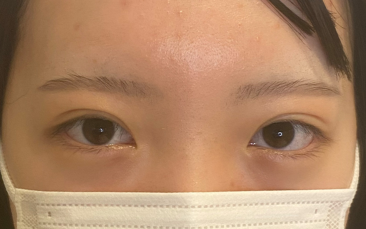 二重埋没法 アフター
