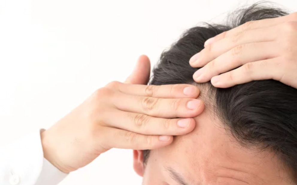 AGAによる生え際の変化を確認する男性